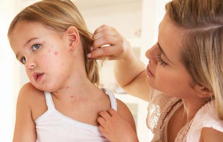 Спалах кору в Україні: що треба знати про хворобу і як захистити себе